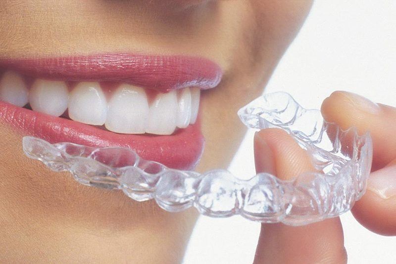 Invisalign, l'appareil dentaire invisible et amovible.