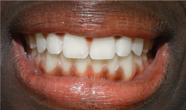 Résultat après fermeture d'un diastème chez B And Smile Genève