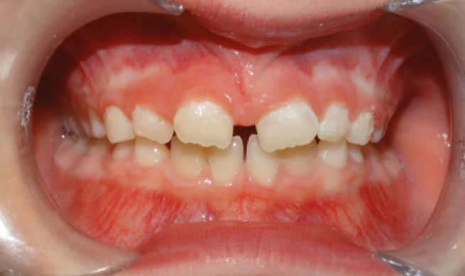 Résultat après correction d'une supraclusion dentaire chez B And Smile Genève
