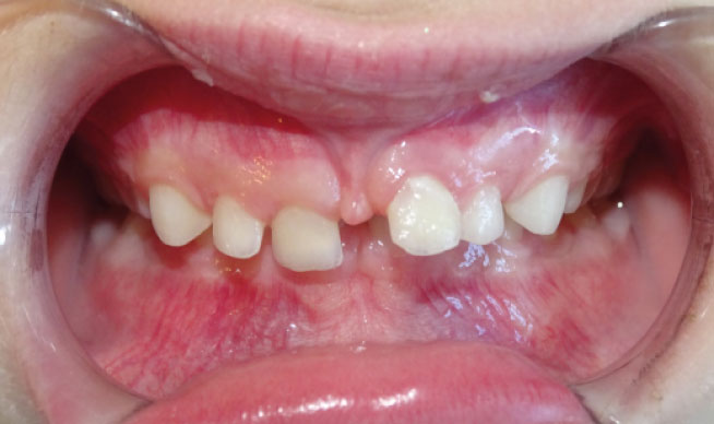 Avant traitement, dents du haut recouvrent les dents du bas (supraclusion) à Genève
